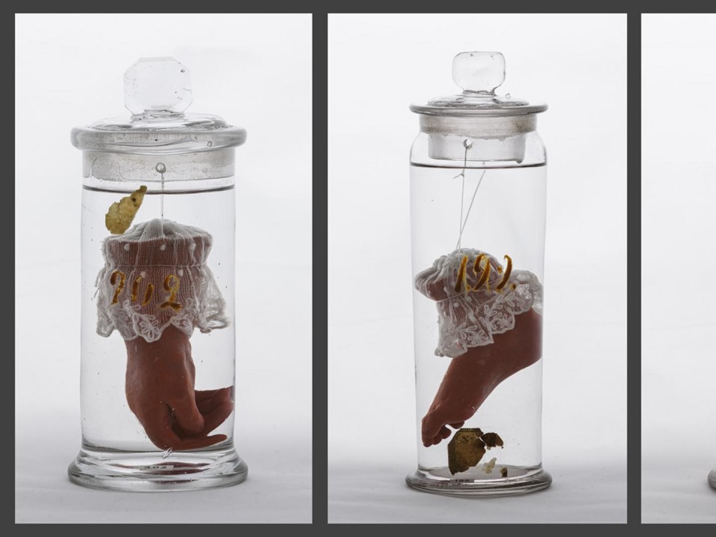 Three wet preparations from the “small collection of 26 dry and wet objects” by Frederik Ruysch, part of the Frederik Ruysch collection. This small collection was privately owned by Tsar Peter the Great and is housed in the museum of the Department of Anatomy of the Military Medical Academy called SM Kirov.
